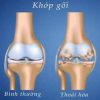 Thoái hóa khớp gối – Kẻ thù thầm lặng của tuổi già